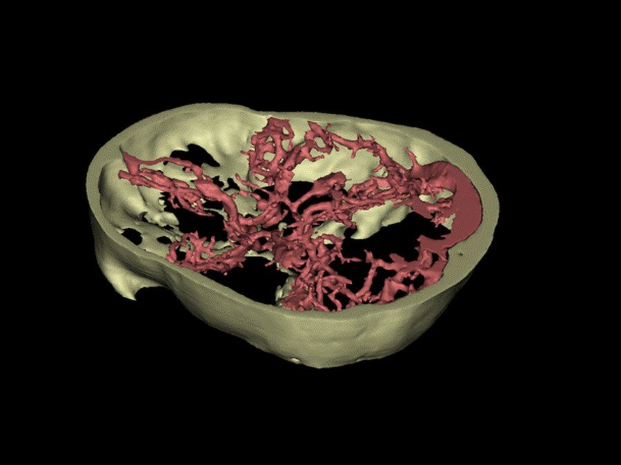 Reconstrucción 3D por angiotac de las arterias cerebrales (círculo de Willis)