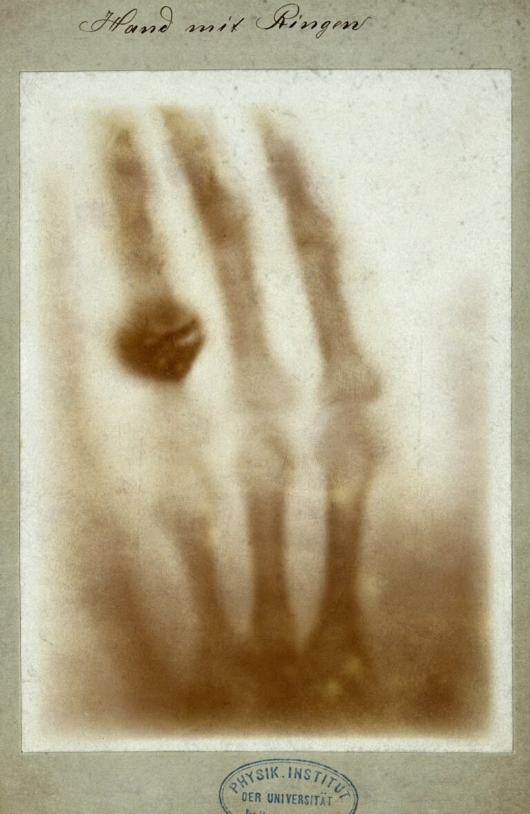 Radiografía original de 1895 de la mano de Anna Bertha Ludwig, esposa de Wilhelm Röntgen, mostrando los huesos y el anillo de matrimonio
